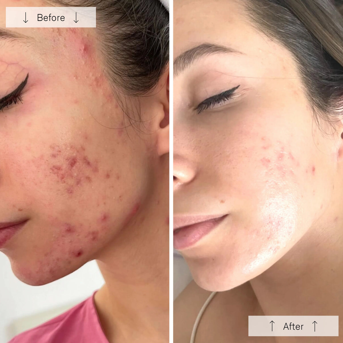 Omnilux Clear LED acne light therapy mask