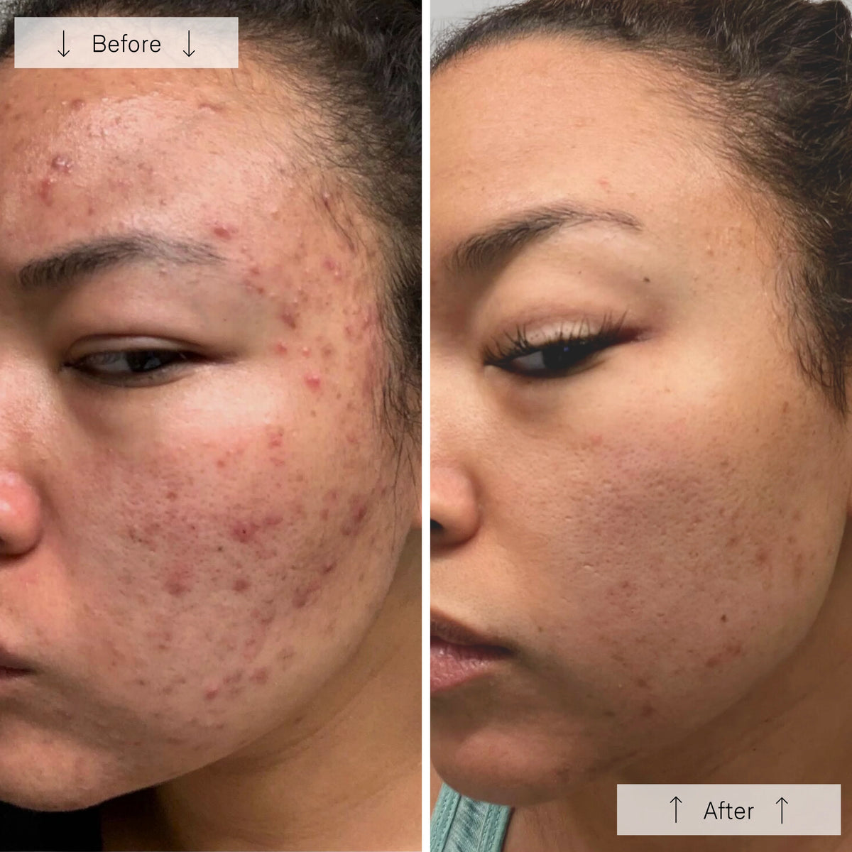 Omnilux Clear LED acne light therapy mask