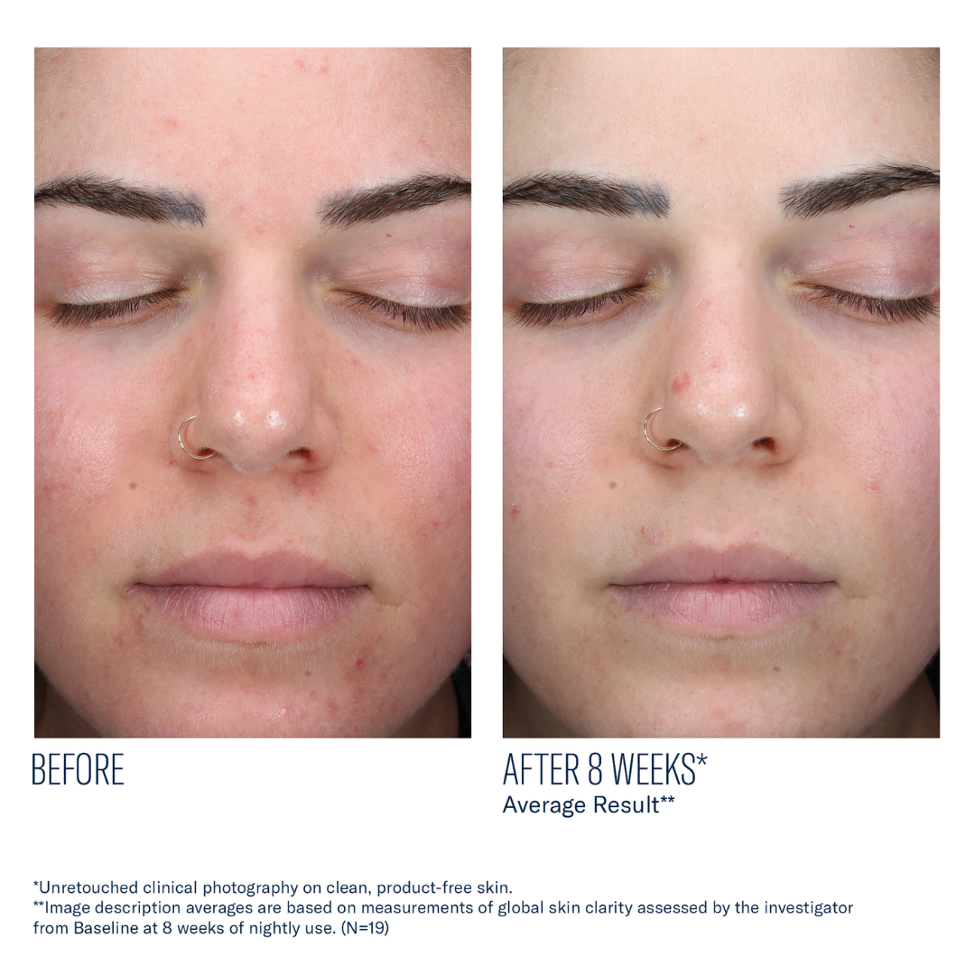 Skinbetter Science AlphaRet Clearing Serum